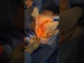 Download Lagu Transgender TOP Surgery! Before and After with Amazing Results!