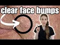 How To Clear And Prevent Face Bumps Sebaceous Hyperplasia
