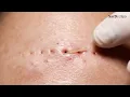 Download Lagu The MOST Satisfying Blackhead Removal Routine for Clear Skin! 🧖‍♀️✨