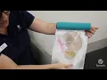 Caesarean section explained
