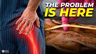 Why Sciatica is So Hard To Fix