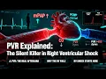 PVR Explained The Silent Killer in Right Ventricular Shock