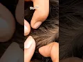 The lice are collected on a plate #lice #shortsviral #shortsvideo #shortsfeed #shorts
