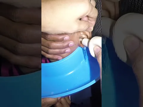 Removing RICE GRAIN Stuck in Boy's Ear