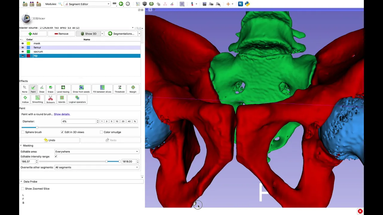 CT Scan to STL for Importing into FeBio Studio using 3DSlicer