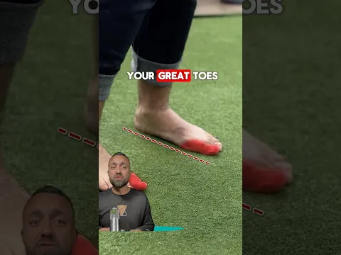 How Weak Glutes Cause Bunions