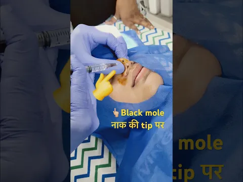 Bad looking black mole at nose tip : Doctor removed #black #mole #nose #viral #trending