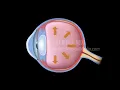 Development of Glaucoma Animation, Open Angle vs Angle Closure Glaucoma.