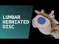 Lumbar Herniated Disc