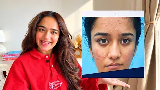 I Had Acne Since I Was 13… This Is What Finally Cleared My Skin #acne #skincare #pimple