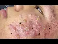 Big Cystic Acne Blackheads Extraction Blackheads Milia Whiteheads Removal Pimple Popping 1687