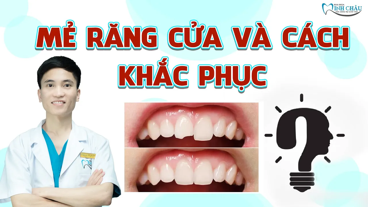 Outline Video Răng Cửa Bị Mẻ Phải Làm Sao? | Nha Khoa Minh Châu
