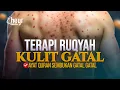 Download Lagu TERAPI RUQYAH GATAL GATAL PADA KULIT - AYAT RUQYAH