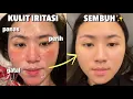 Lagu 3 Tips Atasi KULIT WAJAH IRITASI dengan CEPAT! (Panas, Perih, Gatal)