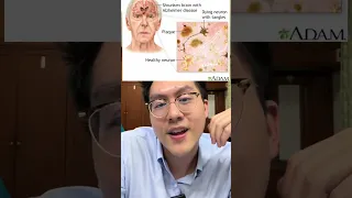  ยาต้านซึมเศร้าบางตัวทำให้ลืมได้หรือไม่ และมีกลไกอย่างไร 