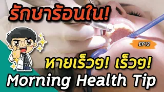 ควรหลีกเลี่ยงน้ำยาบ้วนปากชนิดใดเมื่อมีแผลในปาก