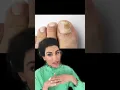 Nail Fungus