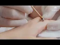 Wart and verruca removal with SILVERIN Silver Nitrate Applicators