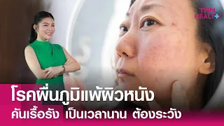 ใครมีความเสี่ยงต่อการเป็นโรคผื่นภูมิแพ้ผิวหนังมากกว่าคนอื่น