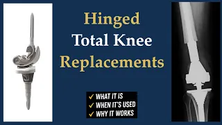 Hinged Total Knee Replacements - Orthopedic Surgeon Explains