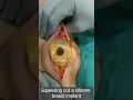 Download Lagu Squeeze Out Your Silicone Breast Implant Safely - Removal of Breast Implant - Squeezing Out Silicone
