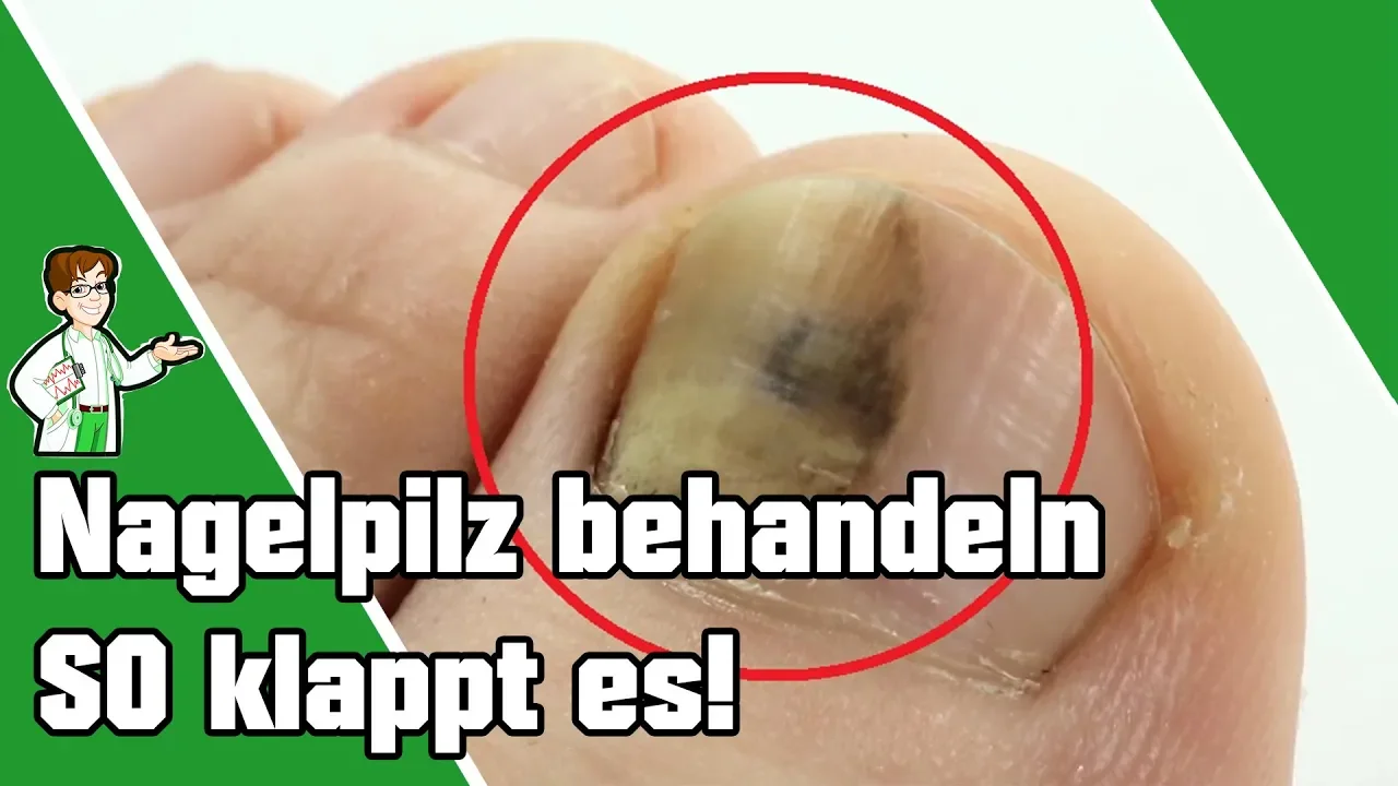 Nagelpilz behandeln mit Nagelspray. 