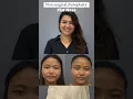 Non Surgical Rhinoplasty For Flat Nose Flat Nose Reshaping Before After