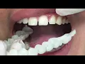Houston Cosmetic Dentist Gaps What Gaps Affordable removable Snap-on Smile to the rescue