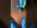 Stretch Marks Inkless Removal Boleyn Treatment Los Angeles
