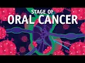 Download Lagu What is TNM Staging? How do We do Staging of Oral Cancer?