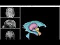 How to read an MRI of the brain