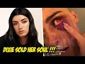Dixie D Amelio Addresses ILLUMINATI Rumors After Getting A Black Eye