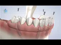 Full-Arch Restoration at Muir Oral Facial Dental Implant Surgery in Walnut Creek CA