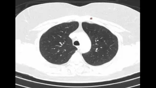 Radiologia para Estudiantes: TC PULMON Y TRAQUEA