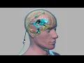 External Ventricular Drain EVD