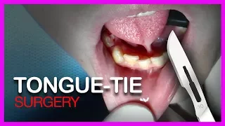 Download Tongue Tie  SURGERY MP3