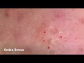 Gabriela s 2nd Acne Treatment Blackheads Extractions