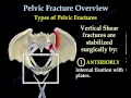 Pelvic Fracture Overview - Everything You Need To Know