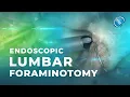 What is Endoscopic Lumbar Foraminotomy