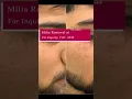 Download Lagu How Much Do You Know about Milia Removal? Milia Removal at Skinaaclinic #milia_removal #miliaremoval