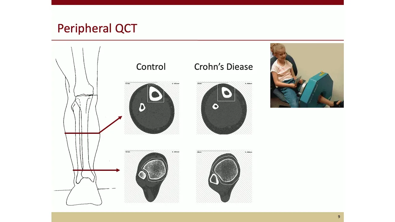 Sexual Dimorphism in Skeletal Development, Mary Leonard, MD, MSCE, Stanford Medicine