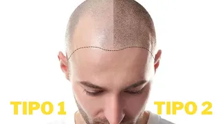 QUAL SEU TIPO DE CALVÍCIE? TRATAMENTOS PARA QUEDA DE CABELO.