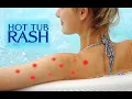 Hot Tub Rash - Causes and Solutions