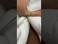 Hidden Acne 036