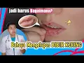 Penyebab BIBIR KERING | Bahaya Mengelupas Kulit Bibir Kering \u0026 Pecah-Pecah || dr. Andi Septiawan