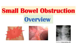 Small Bowel Obstruction SBO Risk Factors Causes Signs Symptoms Diagnosis Treatment