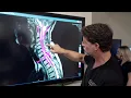 Symptoms of Cervical Stenosis Jeffrey Cantor MD