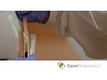 Preparing Platelet-Poor Plasma for Coagulation Testing
