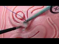 18 102MUL Laparoscopic Intracorporeal Suturing Fundamentals and Tips Tricks for New Learners