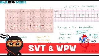 Rate And Rhythm Supraventricular Tachycardia SVT And Wolff Parkinson White WPW Syndrome 